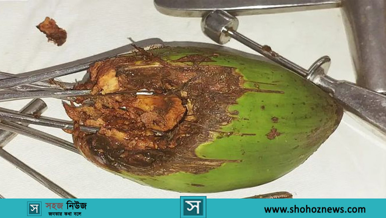 যুবকের পায়ু পথ থেকে বের করা হলো আস্ত ডাব